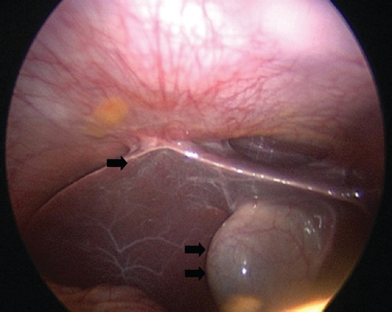 Laparoscopy showing Fitz-Hugh-Curtis syndrome (single arrow) and hanging gall bladder sign (double arrow).